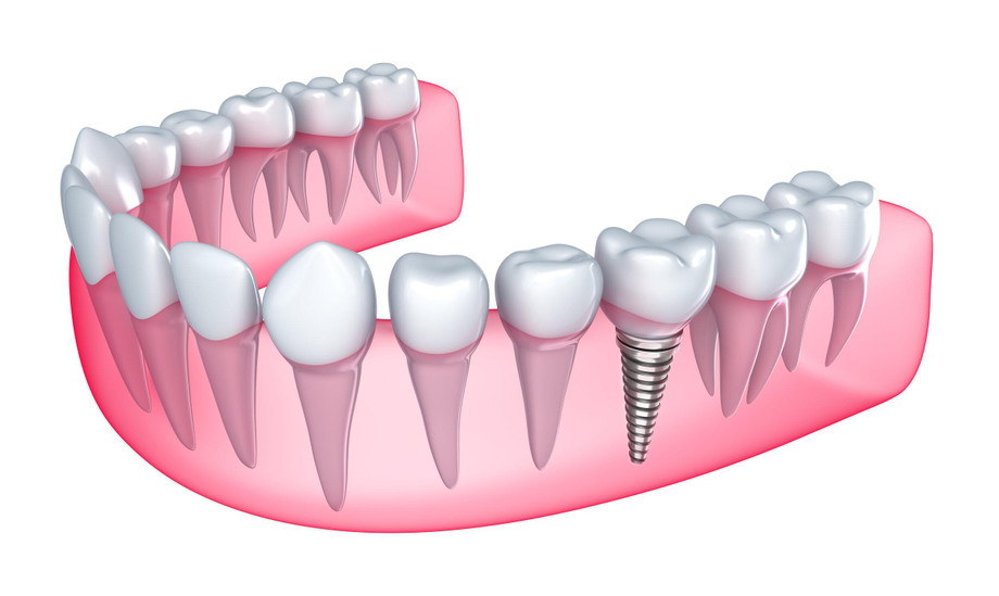 Painless Dental Implants for Seniors: Top Clinics in Mumbai for Comfortable Care