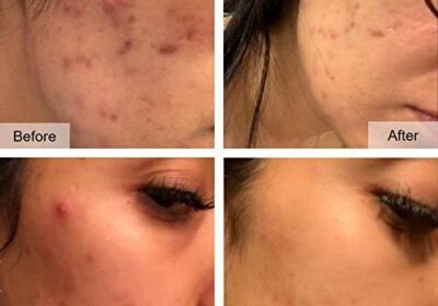 Clear-Acne-Fast