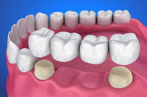 How to Maintain Oral Health After Full Mouth Rehabilitation