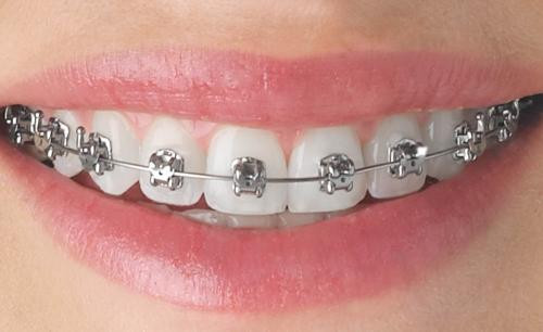 Fluoride Treatment for Braces Wearers: Why It’s Important