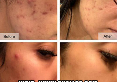 Clear-Acne-Fast-3