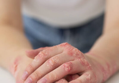 The-Rise-of-Targeted-Therapies-in-Psoriasis-Treatment-in-Kerala