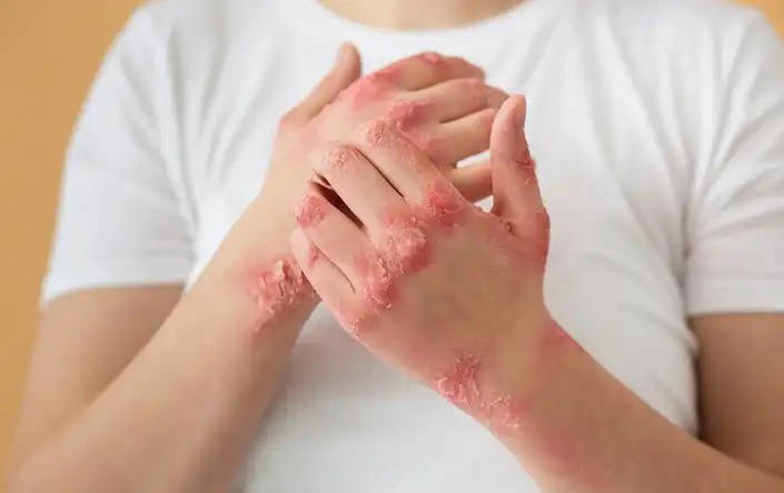 Why Atopic Dermatitis Needs More Than Just Moisturizers