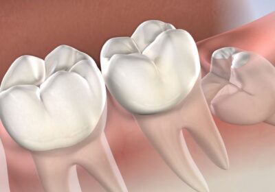Recovery-Tips-After-Wisdom-Tooth-Removal-Treatment-in-Mulund