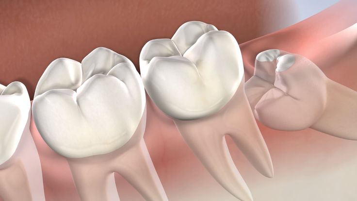 Recovery Tips After Wisdom Tooth Removal Treatment in Mulund