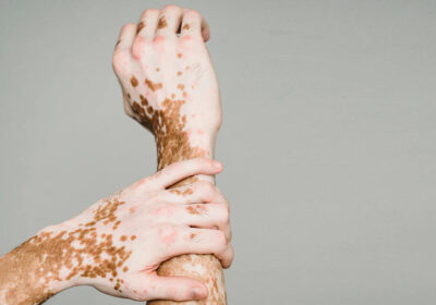 Vitiligo-Treatment-in-Kerala-–-What-Works-What-Doesnt-and-Whats-Next
