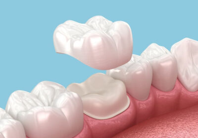 Types-of-Dental-Bridges-Available-in-North-Brunswick-Which-One-Is-Right-for-You