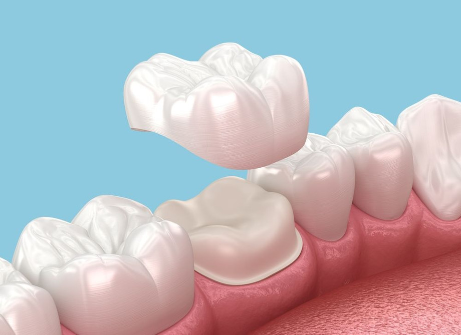 Types of Dental Bridges Available in North Brunswick & Which One Is Right for You